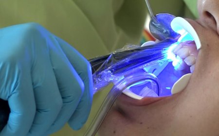 Beyazlatma İşlemlerinde Dikkat: Yanlış Uygulama Diş Kaybına Sebep Olabilir