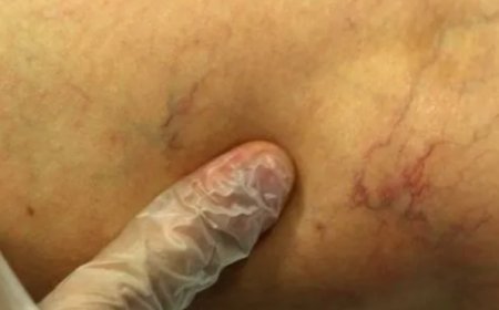 Yaz Mevsiminde Venöz Yetmezlik Riski Artıyor!