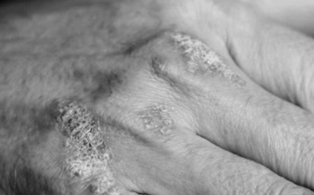 Güneşe dikkat: Alerji vakalarında artış başladı.