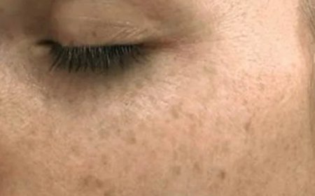 Güneş lekeleriyle mücadelede etkili yöntemler.