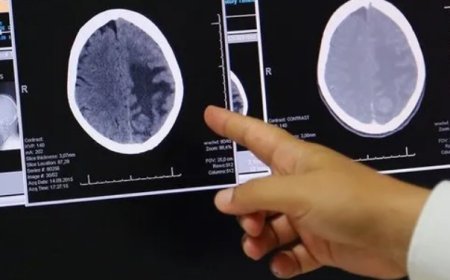 Uzmanlardan Beyin Tümörü Uyarısı: En Kritik Risk Faktörü: Radyasyon!