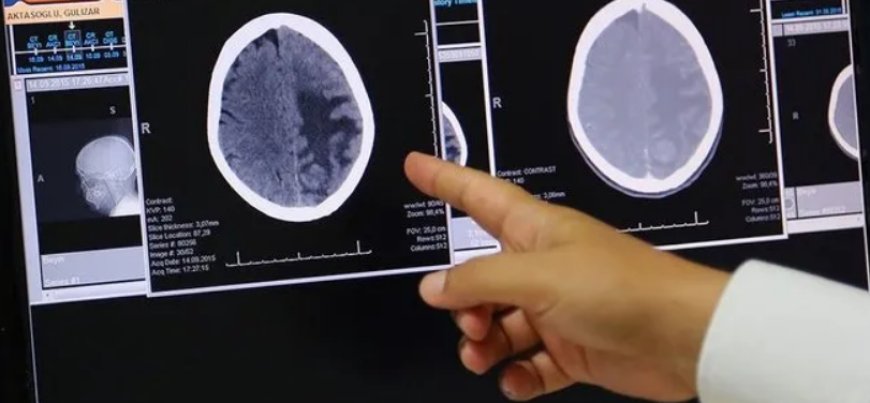 Uzmanlardan Beyin Tümörü Uyarısı: En Kritik Risk Faktörü: Radyasyon!