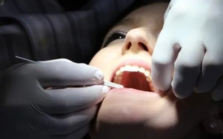 Diş Çürükleri Alarm Veriyor: İlerleyen Çürükler Tehlike Saçıyor!