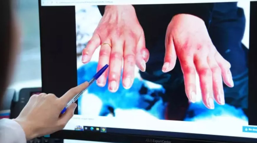 Kış Kapıda, Tehlike Kapıda: Soğuk Isırığına Karşı Uzmanlardan Hayati Uyarılar