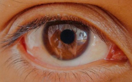 Göz Tansiyonunda Erken Teşhis: Körlüğü Engelleyen En Önemli Adım