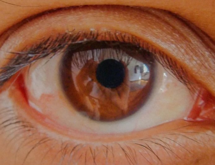 Göz Tansiyonunda Erken Teşhis: Körlüğü Engelleyen En Önemli Adım