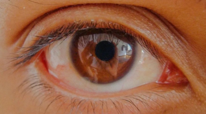 Göz Tansiyonunda Erken Teşhis: Körlüğü Engelleyen En Önemli Adım