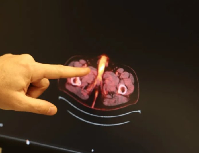 Diyarbakır'da Tıp Dünyasını Şaşırtan Teşhis: Dünyanın 61. Vakası mı?