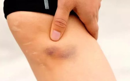 Görünmez Tehlike Pıhtı: Tek Taraflı Şişlik Varsa Vakit Kaybetmeyin