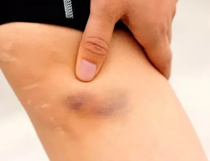 Görünmez Tehlike Pıhtı: Tek Taraflı Şişlik Varsa Vakit Kaybetmeyin