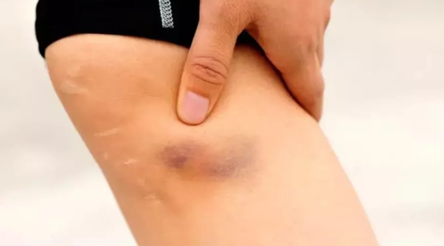 Görünmez Tehlike Pıhtı: Tek Taraflı Şişlik Varsa Vakit Kaybetmeyin