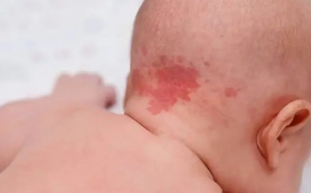 Doğum Lekeleri Nörolojik Hastalıkların İlk İşareti Olabilir
